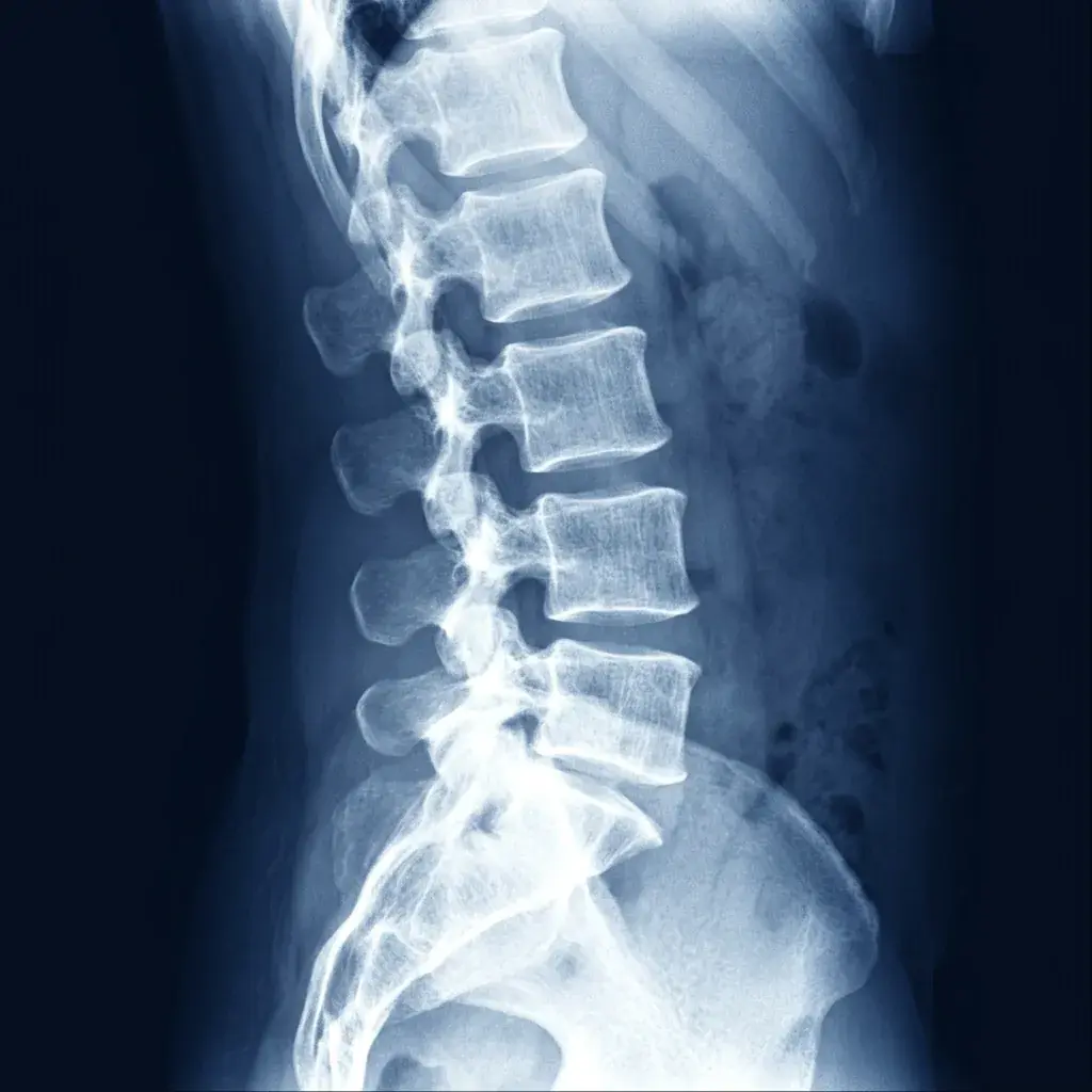 Radiografia laterale di spondilolistesi lombare