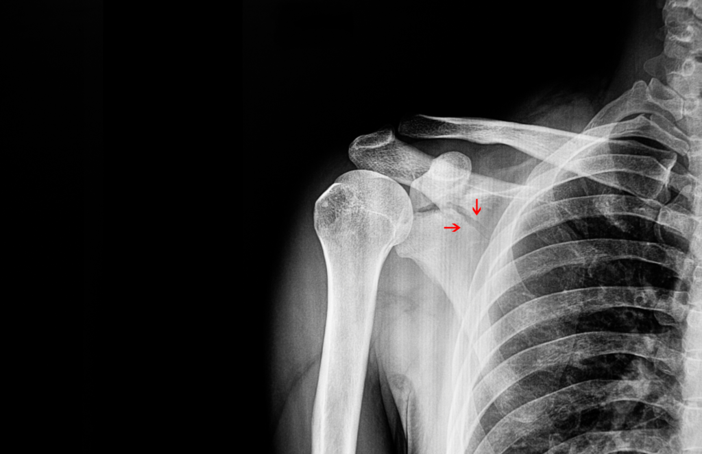 muscolo sottoscapolare