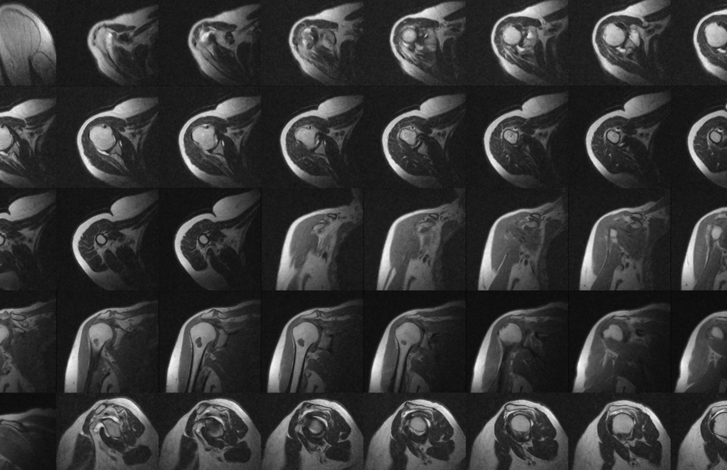 risonanza magnetica cuffia dei rotatori